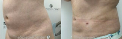BodyTite before and after photo