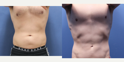 Laser Liposuction before and after photo