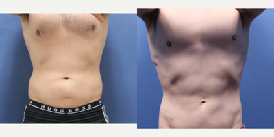 Laser Liposuction before and after photo