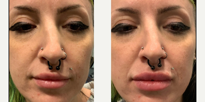 Lip Fillers before and after photo