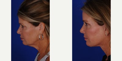 Neck Lift before and after photo