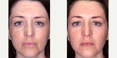 Chemical Peel before and after photo
