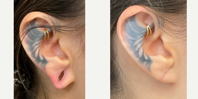 Earlobe Repair before and after photo