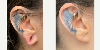 Earlobe Repair before and after photo