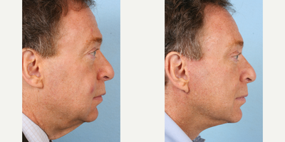 Facelift before and after photo