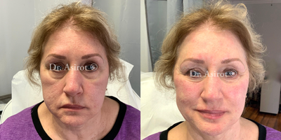 Nonsurgical Facelift before and after photo