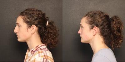 Rhinoplasty before and after photo