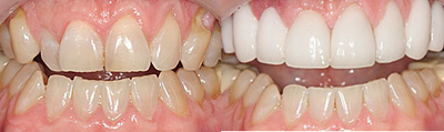 Smile Makeover before and after photo
