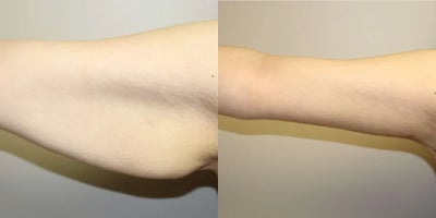 Arm Lift before and after photo