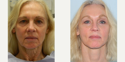 Eyelid Surgery before and after photo