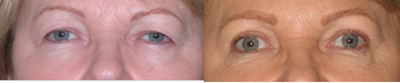 Eyelid Surgery before and after photo