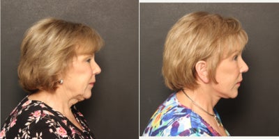 Eyelid Surgery before and after photo