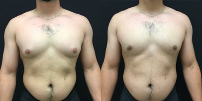 Gynecomastia Surgery before and after photo