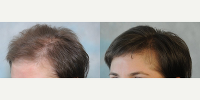 Hair Loss Treatment before and after photo