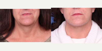 Juvederm before and after photo