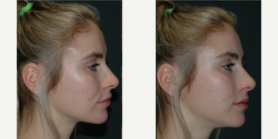 Juvederm before and after photo