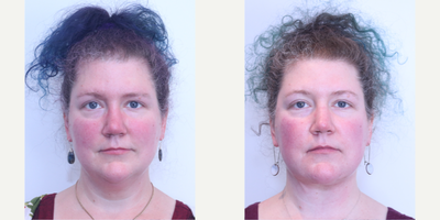 Neck Lift before and after photo