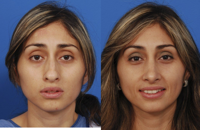 Rhinoplasty before and after photo