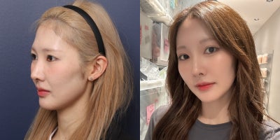 Double Eyelid Surgery before and after photo
