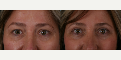 Eyelid Surgery before and after photo