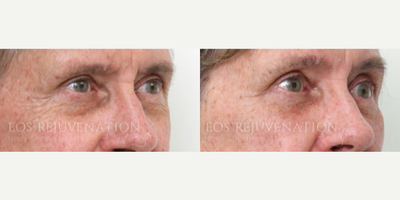 Eyelid Surgery before and after photo