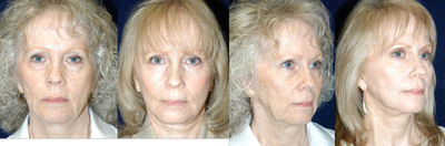 Facelift before and after photo