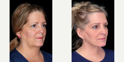 Facelift before and after photo