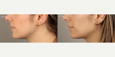 Lip Fillers before and after photo