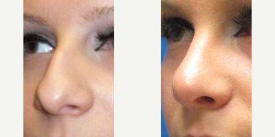 Rhinoplasty before and after photo