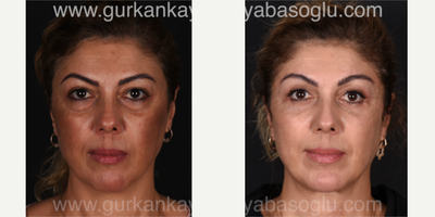 Brow Lift before and after photo