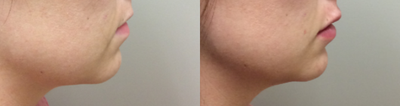 Lip Fillers before and after photo