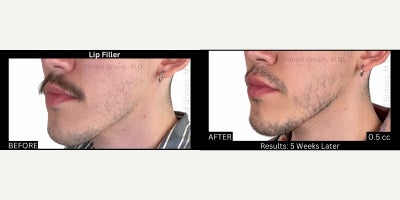 Restylane Kysse before and after photo