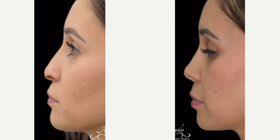 Revision Rhinoplasty before and after photo