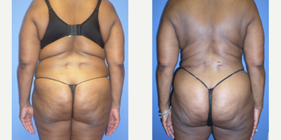 Vaser Liposuction before and after photo