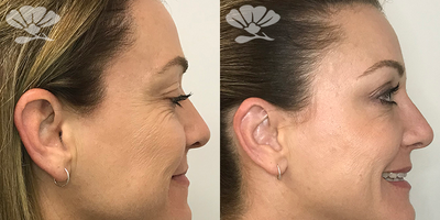 Botox before and after photo