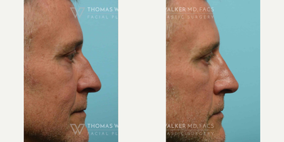 Botox before and after photo