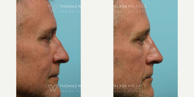 Botox before and after photo