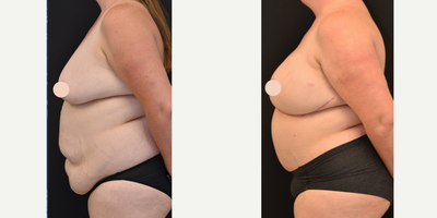 Breast Reconstruction with DIEP Flap before and after photo
