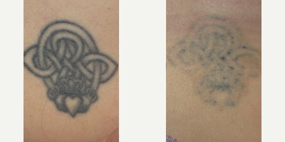PicoSure before and after photo