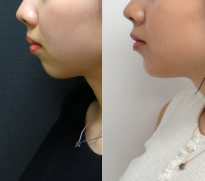 Radiesse before and after photo