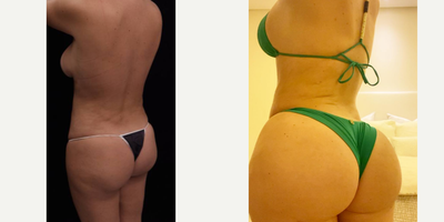 Brazilian Butt Lift before and after photo