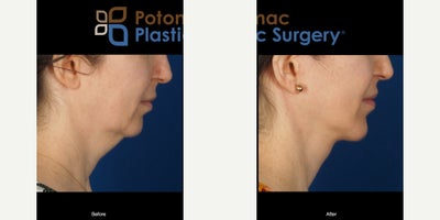 Chin Implant before and after photo