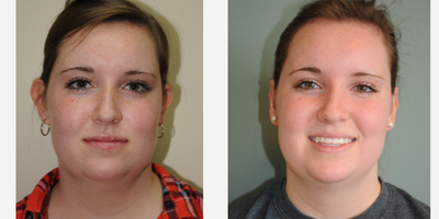 Ear Surgery before and after photo