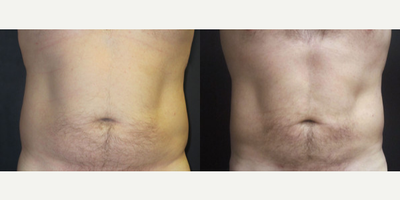 Liposuction before and after photo