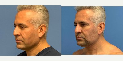 Liposuction before and after photo