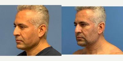 Liposuction before and after photo