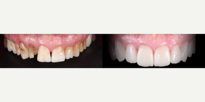 Smile Makeover before and after photo