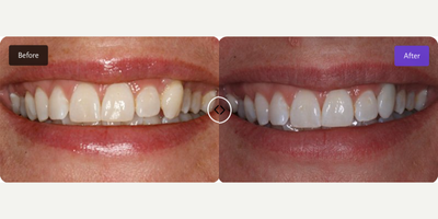 Smile Makeover before and after photo