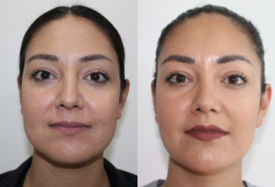 Buccal Fat Removal before and after photo