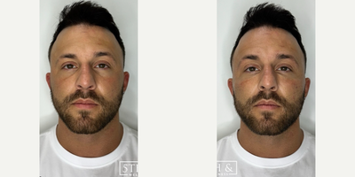 Cheek Fillers before and after photo